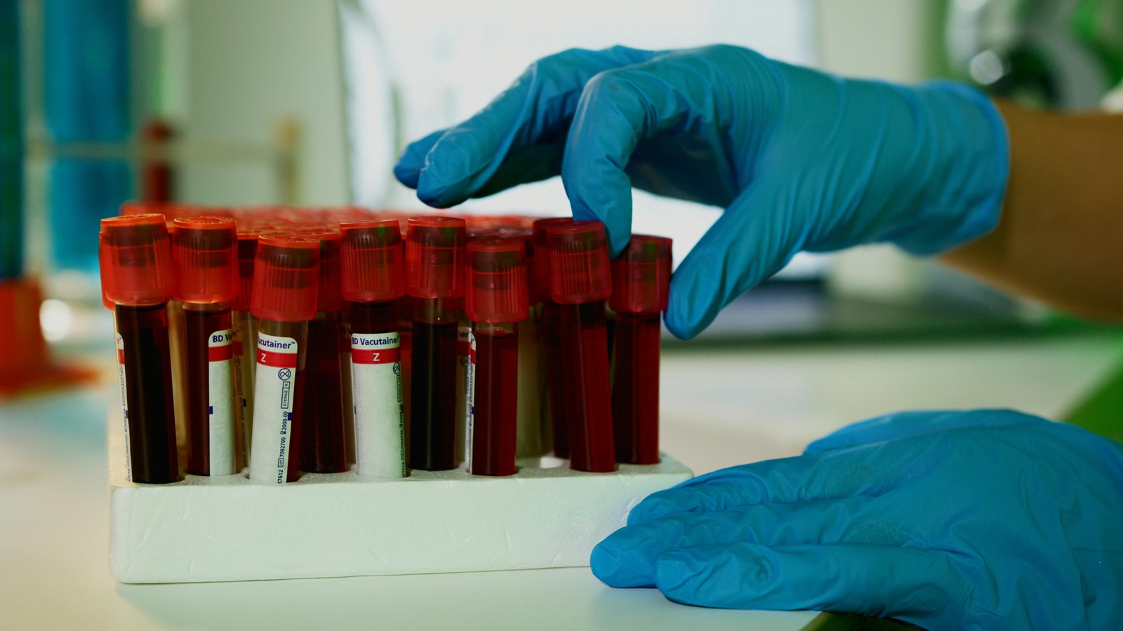 CBC-derived ratios have limited diagnostic value in rheumatic disease tuberculosis