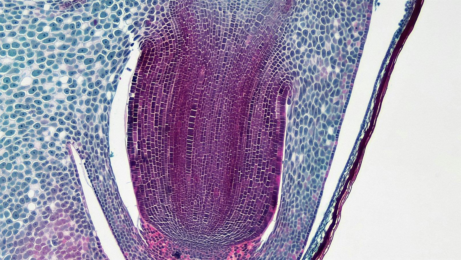 Rare solitary fibrous tumor found in the floor of the mouth