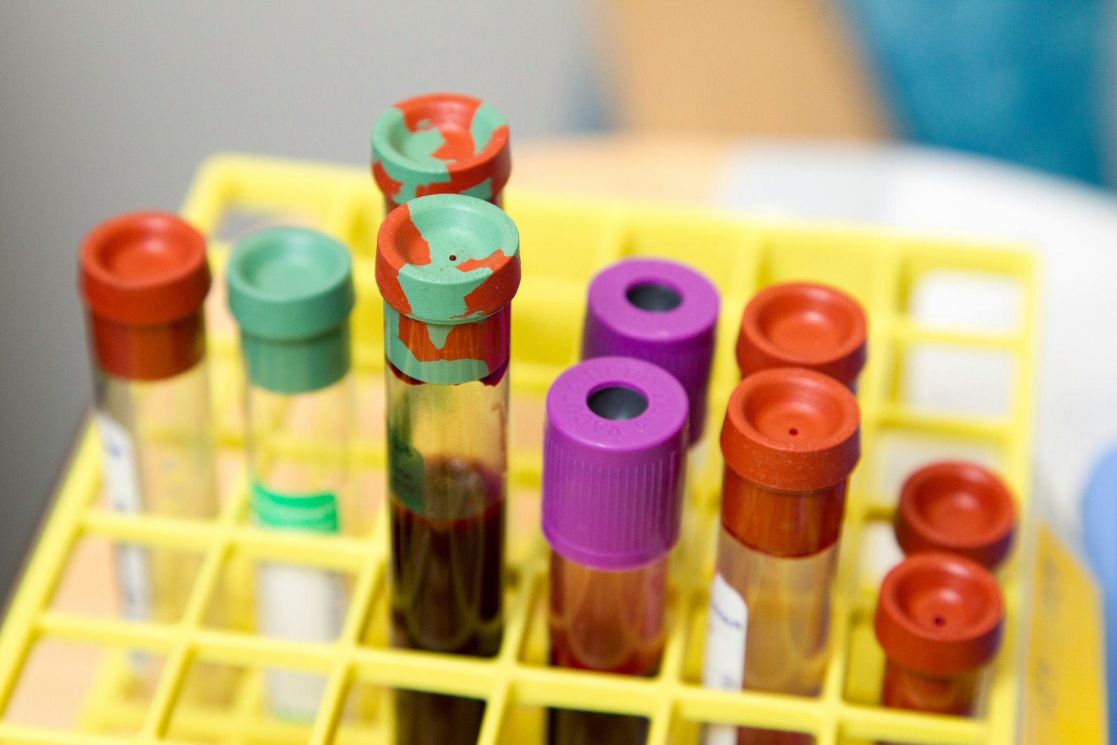 Multiple test tubes with colored caps arranged in a yellow laboratory rack, containing brown liquid samples typical of blood or clinical specimens.