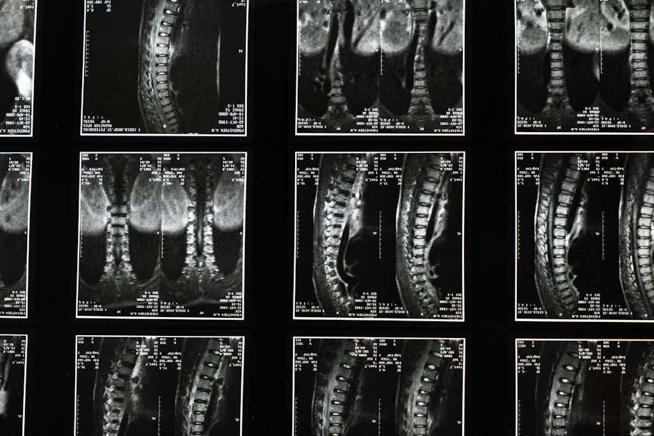 UBE resection completely removed a cervical osteoid osteoma
